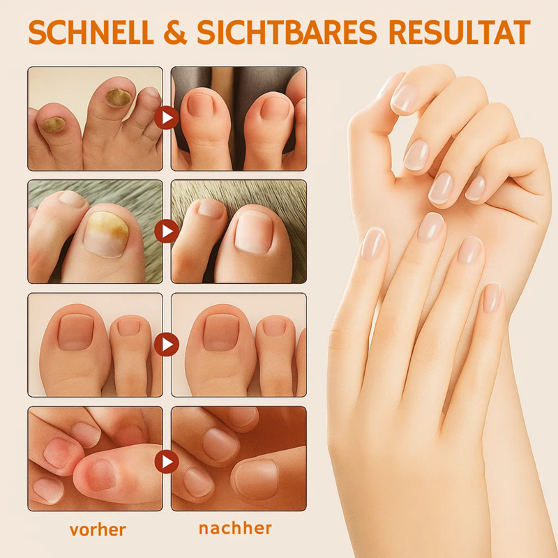 Revitanail™ – Grey Nail Treatment Spray